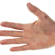 Peter Greven Physioderm: Hautschutz rückt mehr in den Fokus