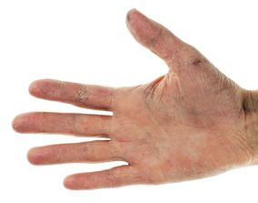 Peter Greven Physioderm: Hautschutz rückt mehr in den Fokus