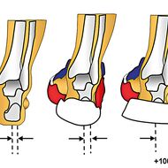 Hebelarme: Unterschätzte Stolperfallen  der Fußbewegung